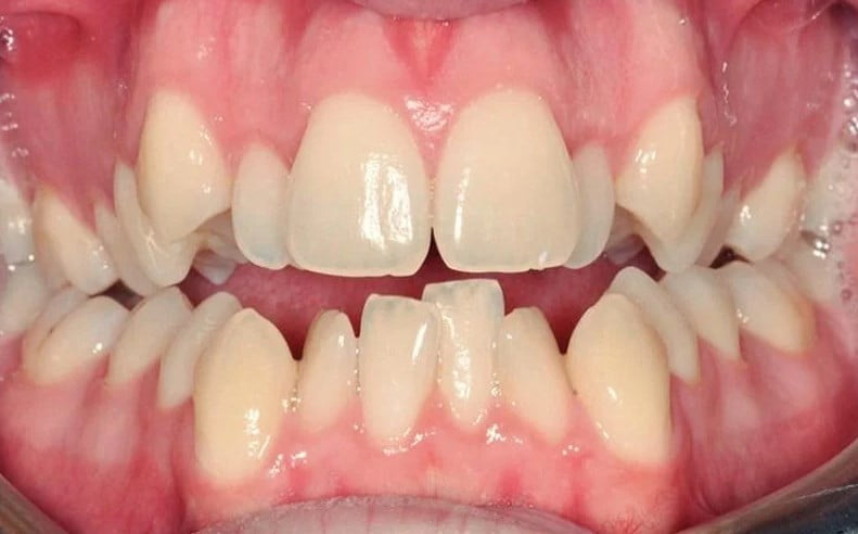 problema dentales frenillos