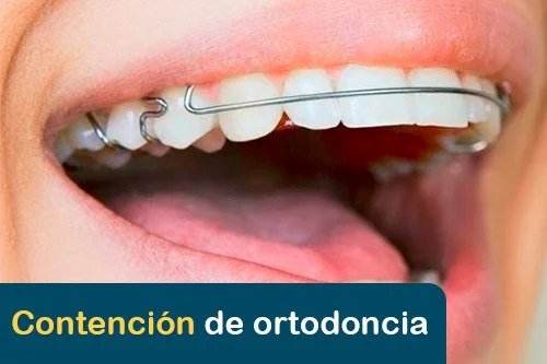 destacada contención de ortodoncia