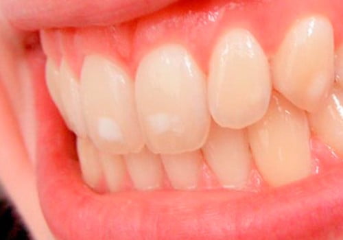 caso-hipoplasia-dental