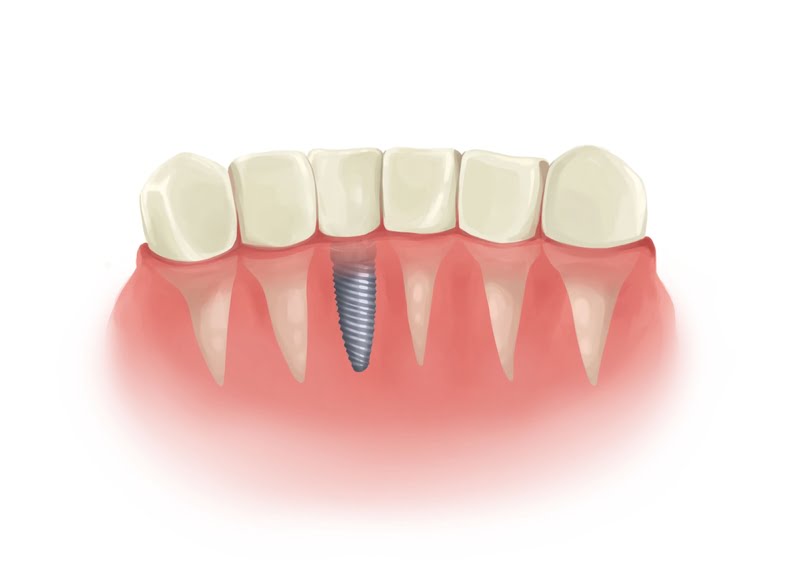 implante-dental-diente